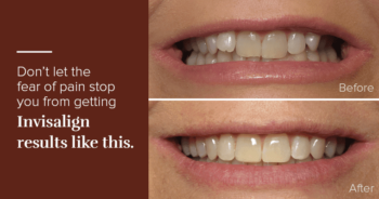 Before and after Invisalign photos with text, "Don’t let the fear of pain stop you from getting Invisalign results like this."