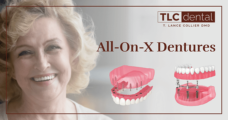 All-On-X Dentures by TLC Dental