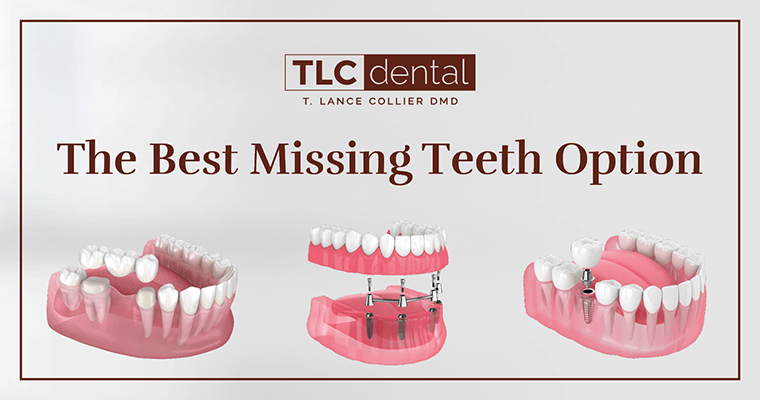 What Are Your Options for Missing Teeth?